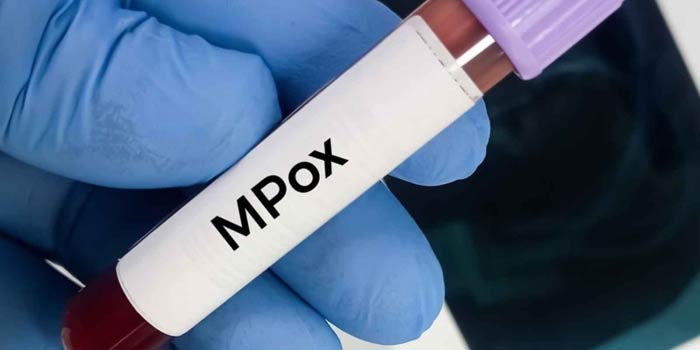 La variole du singe inquiète de par le monde. Le Maroc intensifie sa vigilance: S.O.S MPOX