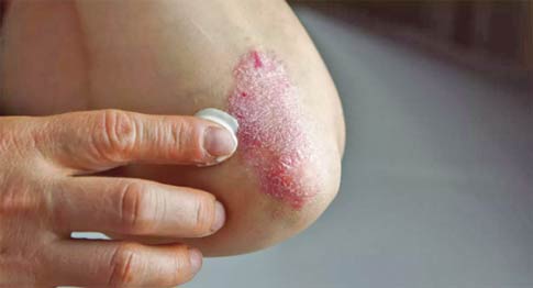 Psoriasis : Le dépistage précoce limite les effets secondaires et garantit une vie normale aux patients Psoriasis : Le dépistage précoce limite les effets secondaires et garantit une vie normale aux patients