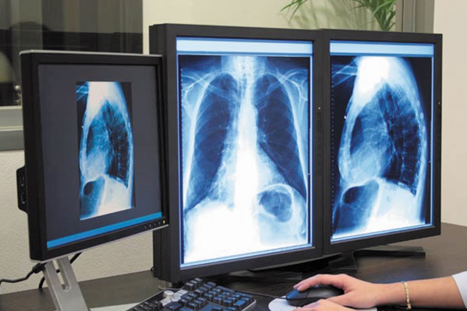 480.000 cas de tuberculose multirésistante recensés  dans le monde en 2014