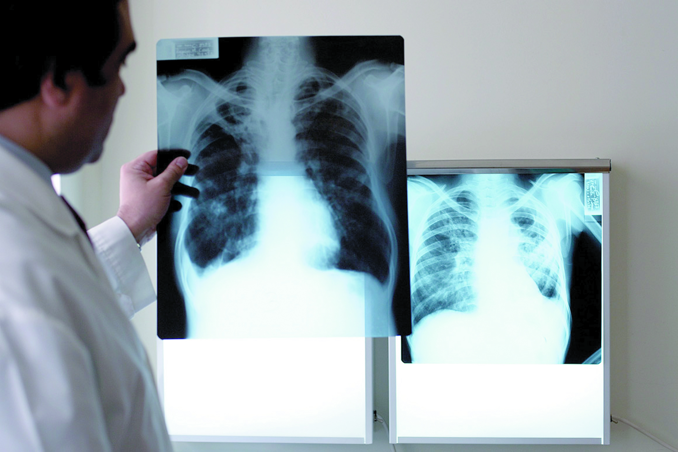 Tuberculose : Le taux d'incidence  et de rechute en baisse à Essaouira