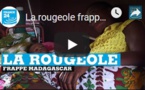 La rougeole frappe Madagascar