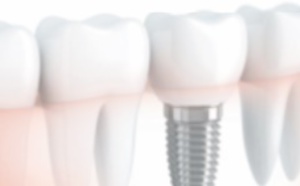 Réponses d’expert : Est-il vrai que les implants dentaires sont déconseillés aux fumeurs ?