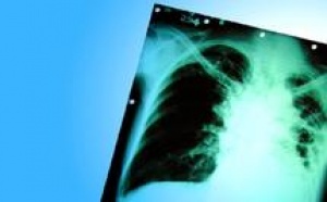 Casablanca, ville la plus touchée par la maladie : 25.500 nouveaux cas de tuberculose déclarés au Maroc
