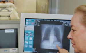 Plus de cancers du poumon chez les jeunes femmes que les jeunes hommes aux USA