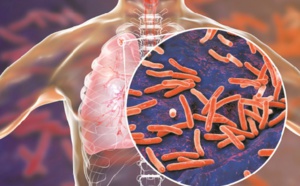 Tuberculose multirésistante: Un nouveau traitement bouleverse la donne