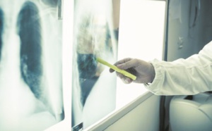 Une femme meurt d’un cancer après avoir reçu les poumons d’une fumeuse
