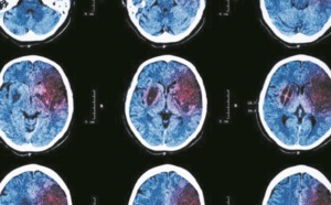 AVC et crise cardiaque pourraient annoncer un cancer 1 mois avant