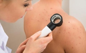 Les bleus, un signe de cancer de la peau