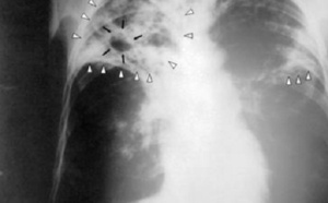 A Casablanca, l’augmentation des cas de tuberculose inquiète les professionnels de santé