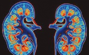 Le diabète, l'hypertension artérielle et la lithiase urinaire pointés du doigt