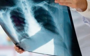 Extension du plan national de prévention et de contrôle de la tuberculose