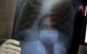 Un nouveau traitement pour soigner les tuberculoses multirésistantes