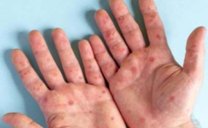 Variole du singe. Aucun cas détecté au Maroc depuis des mois