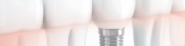 Réponses d’expert : Est-il vrai que les implants dentaires sont déconseillés aux fumeurs ?