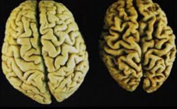 L'inflammation du sang liée à un risque accru d'Alzheimer