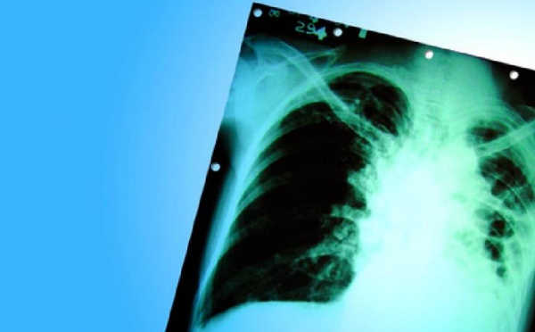 Casablanca, ville la plus touchée par la maladie : 25.500 nouveaux cas de tuberculose déclarés au Maroc