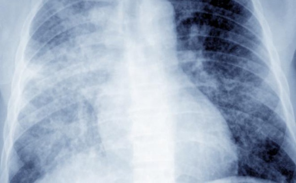 Stratégie «Halte à la tuberculose» : Détection et prise en charge gratuite de 25.000 nouveaux cas