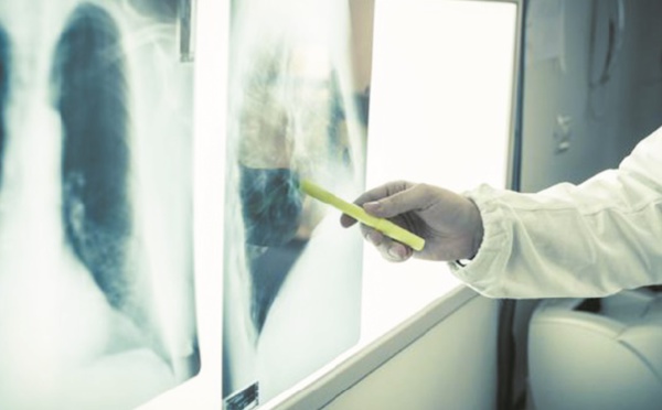 Une femme meurt d’un cancer après avoir reçu les poumons d’une fumeuse
