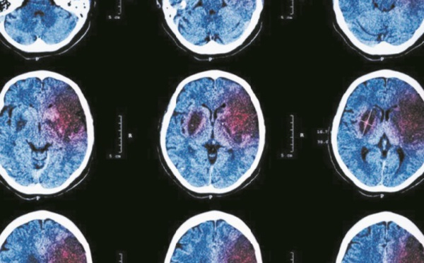 AVC et crise cardiaque pourraient annoncer un cancer 1 mois avant