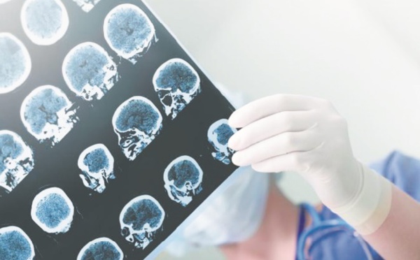 Alzheimer La faute à la circulation sanguine ?