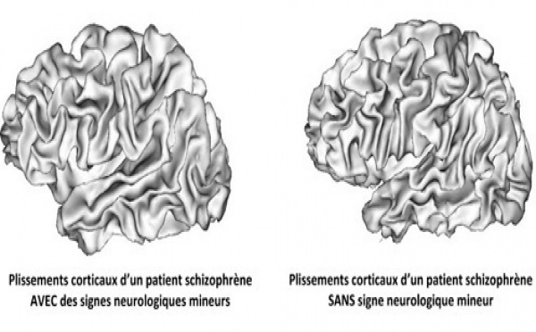 Schizophrénie : la piste des plis cérébraux