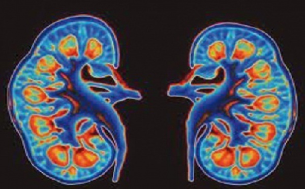 Le diabète, l'hypertension artérielle et la lithiase urinaire pointés du doigt