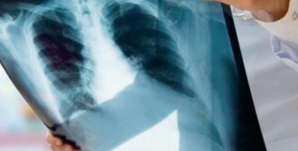 Extension du plan national de prévention et de contrôle de la tuberculose