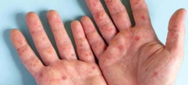 Variole du singe. Aucun cas détecté au Maroc depuis des mois